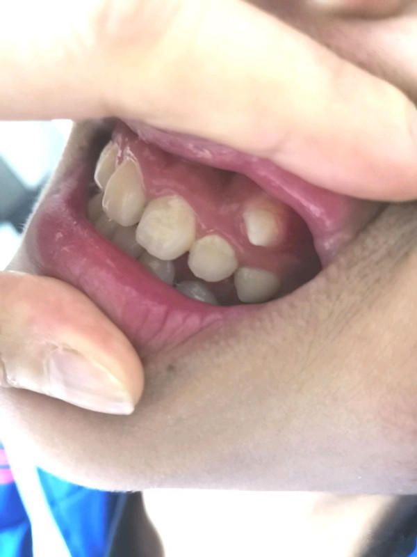 孩子牙龈上长了一颗牙齿池州有办法矫正吗