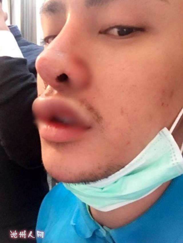 泰国男生自爆花了6万元在脸上动刀30次晒出整容前后对比图迅速走红