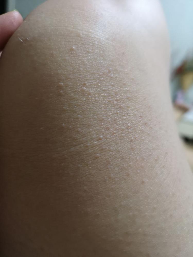 局部鸡皮疙瘩发痒(局部起鸡皮疙瘩 痒)