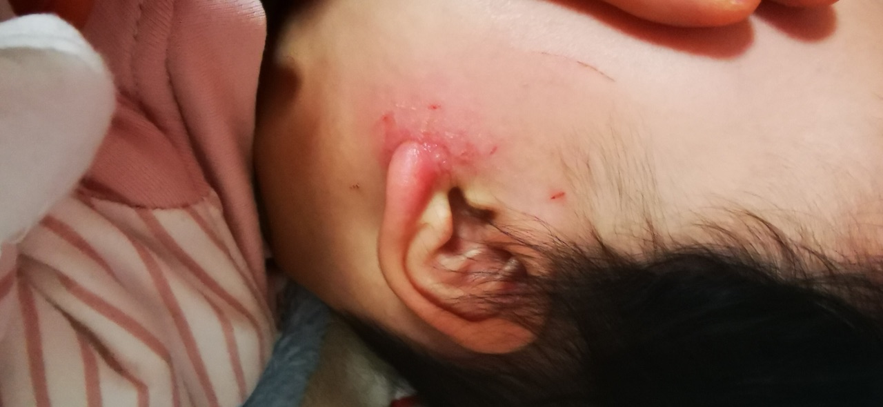 婴儿湿疹耳朵流脓图片图片